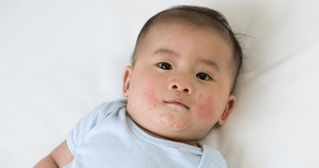 Handling Common Baby Skin Problems